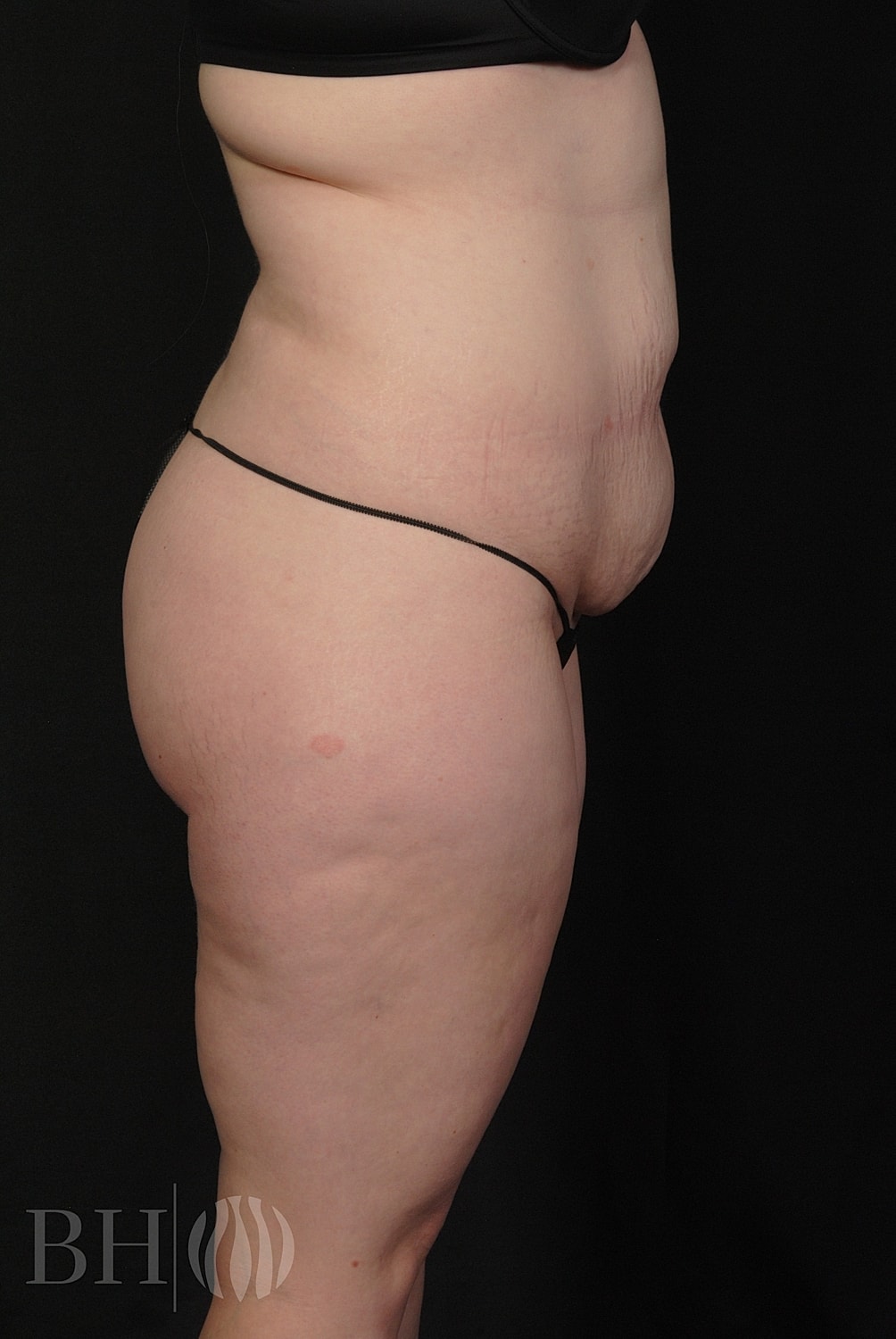Tummy Tuck Before & After