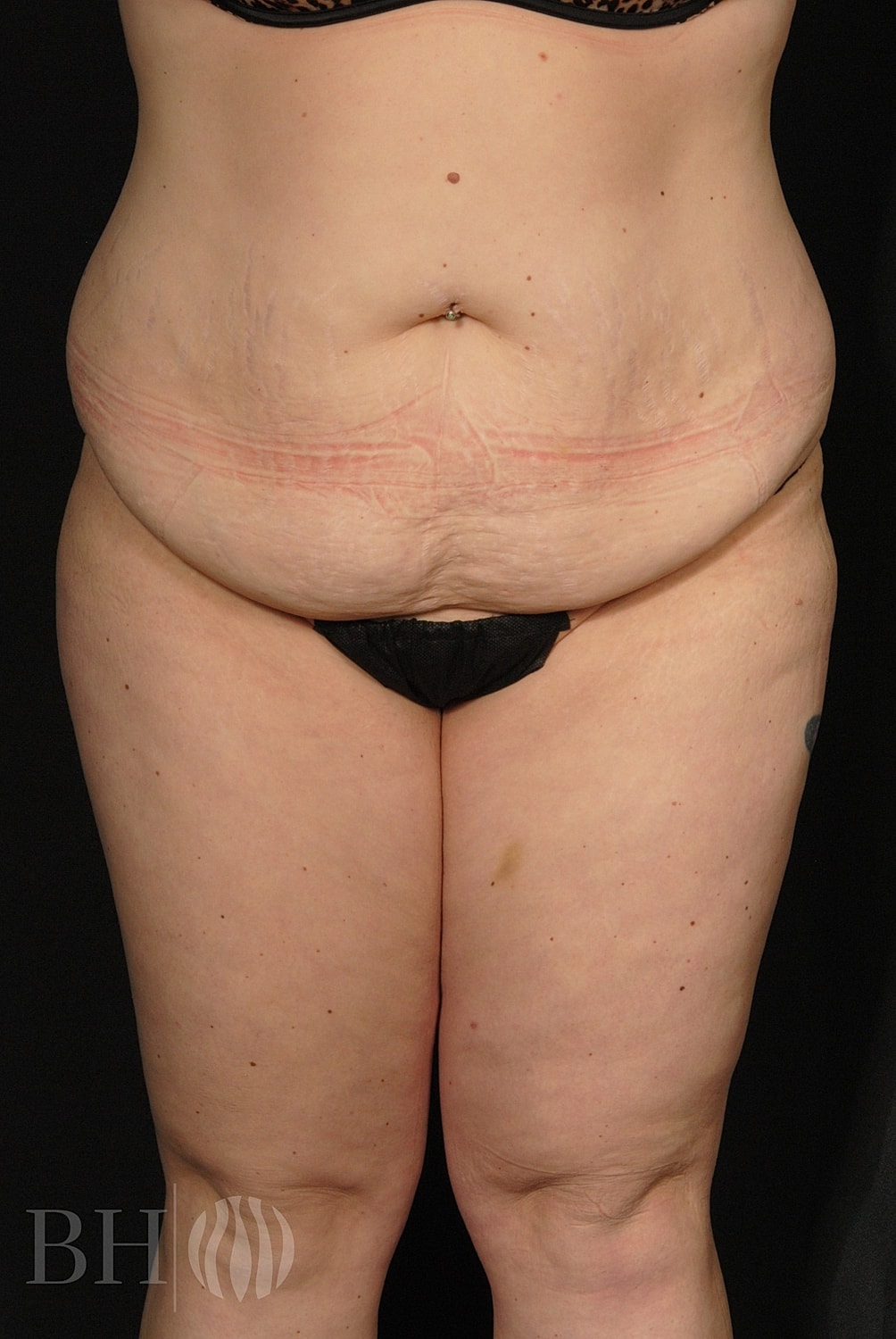 Tummy Tuck Before & After