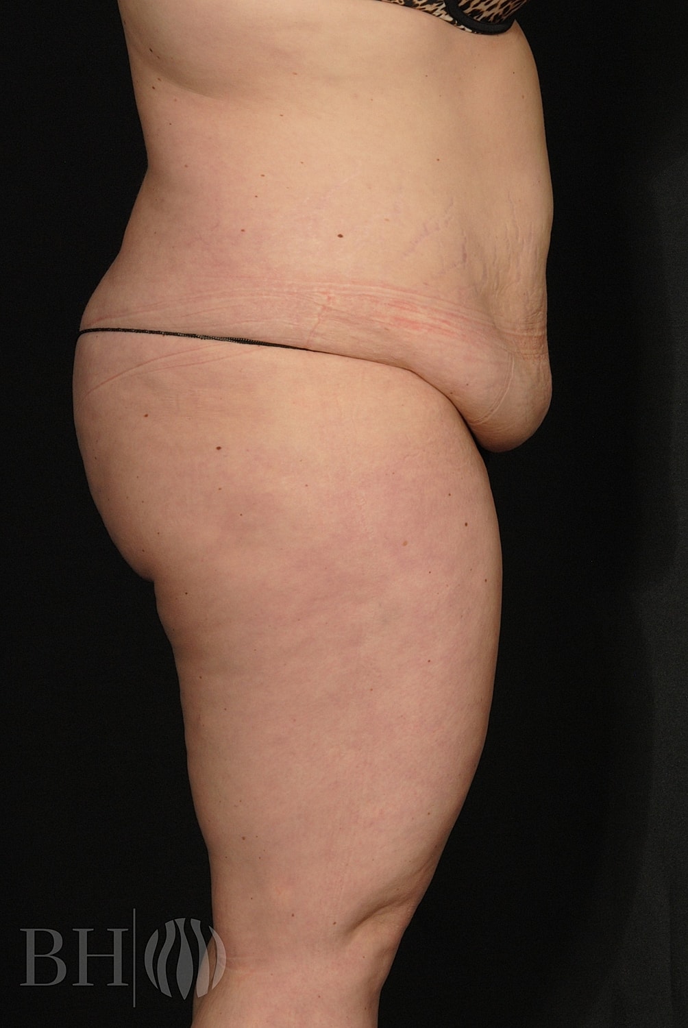 Tummy Tuck Before & After