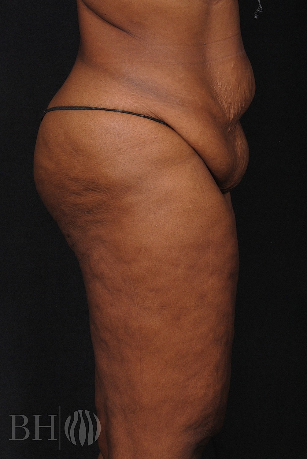 Tummy Tuck Before & After