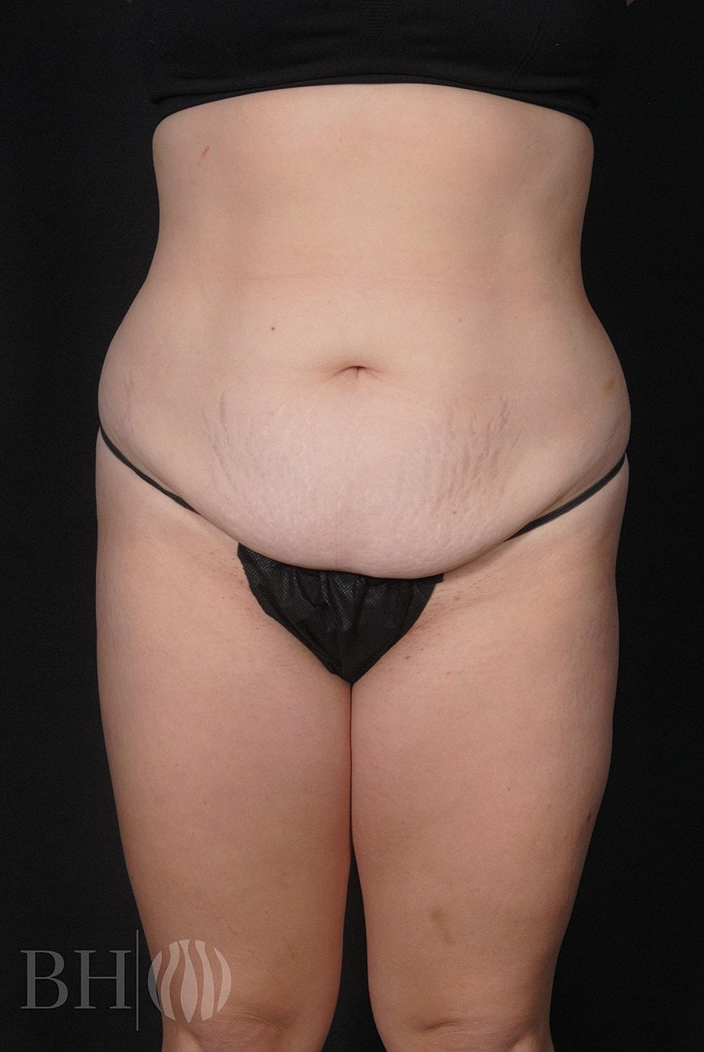 Tummy Tuck Before & After