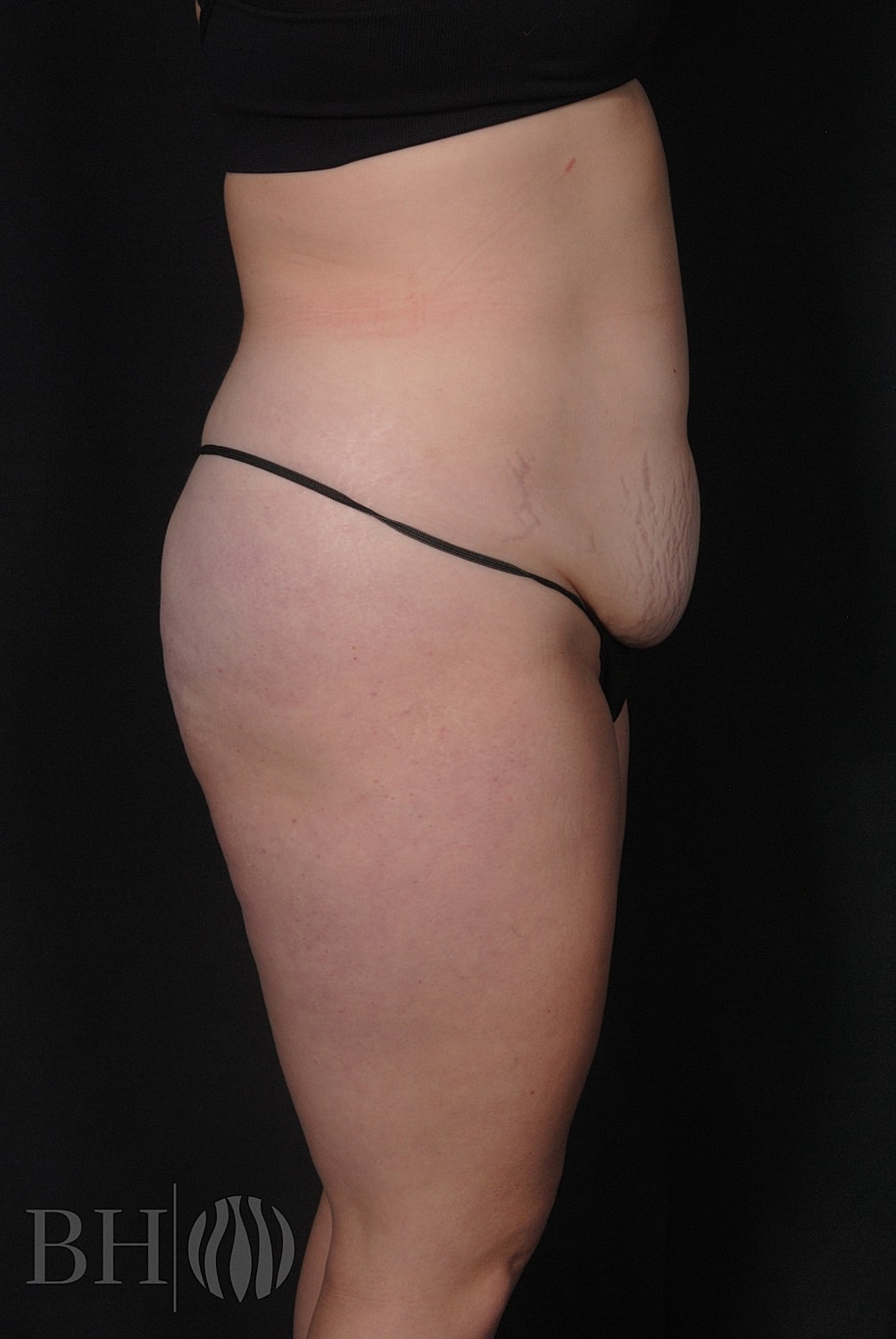 Tummy Tuck Before & After
