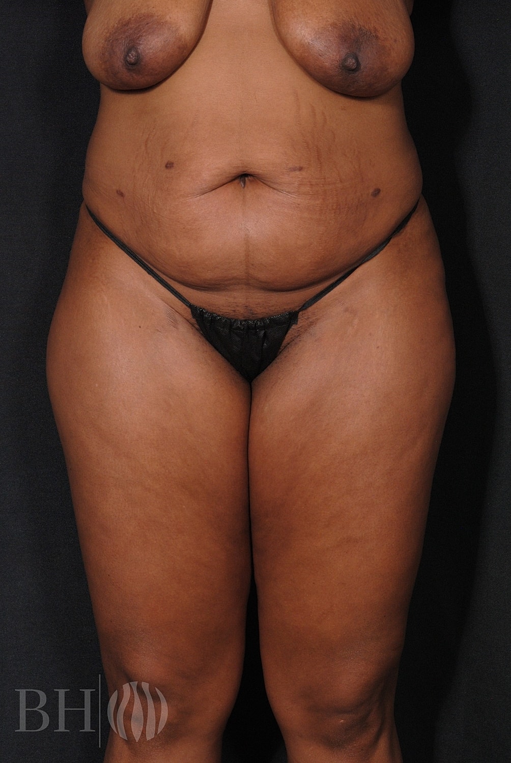 Tummy Tuck Before & After