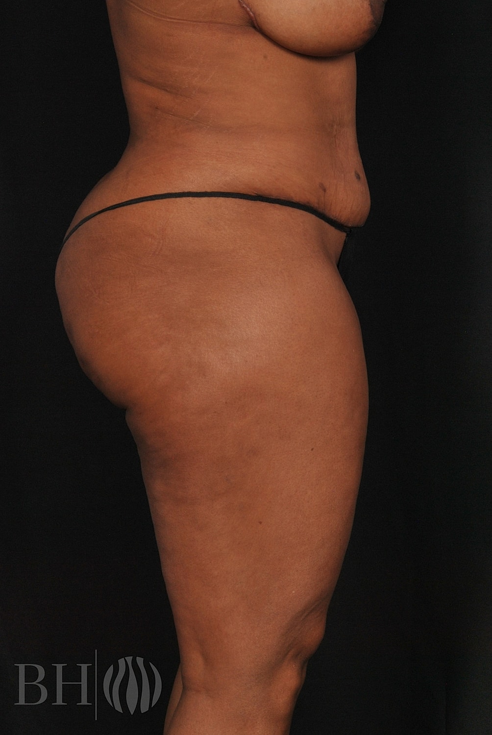 Tummy Tuck Before & After