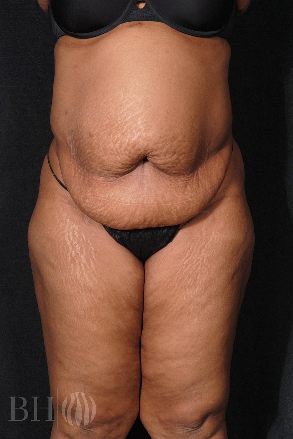 Tummy Tuck Before & After
