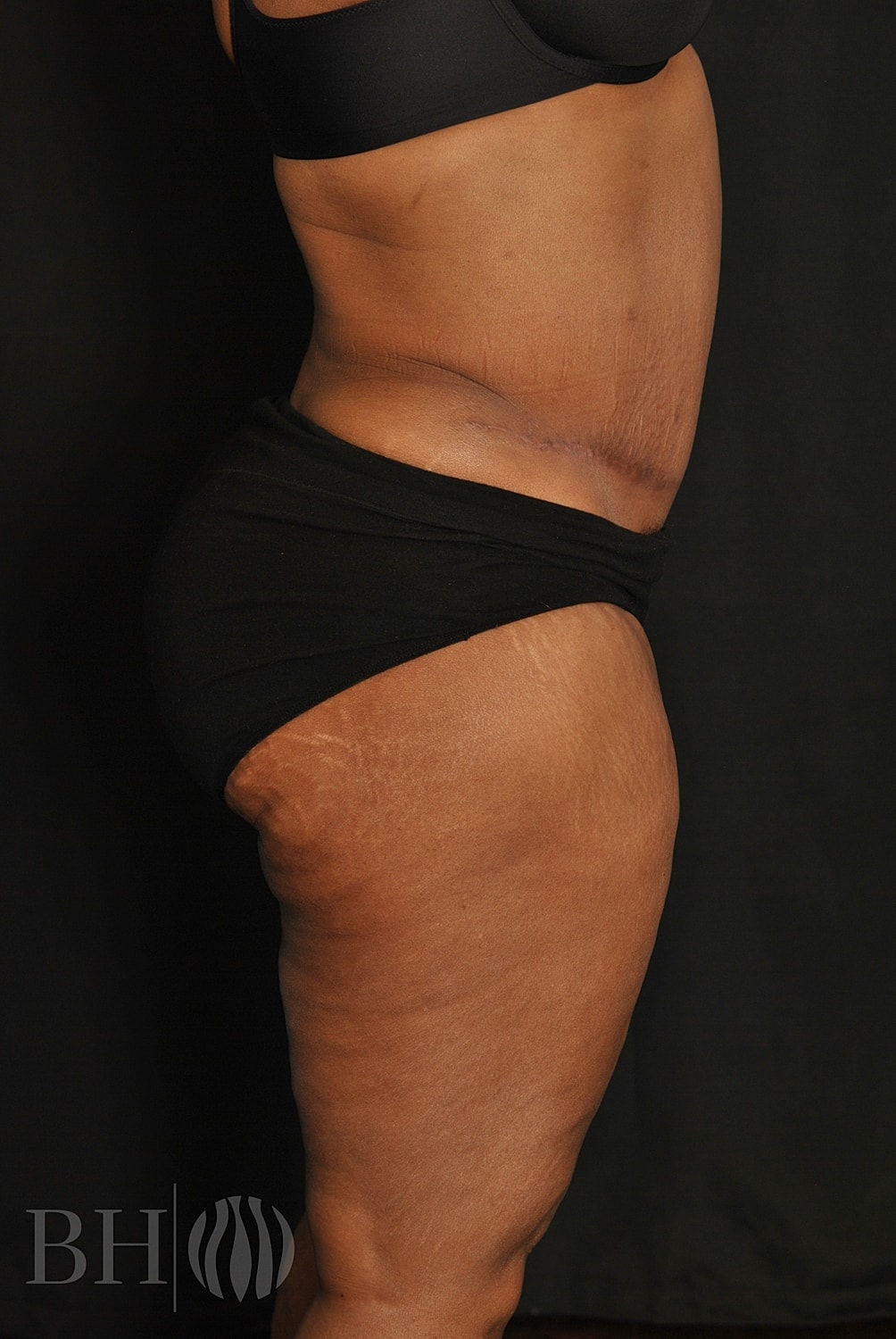 Tummy Tuck Before & After