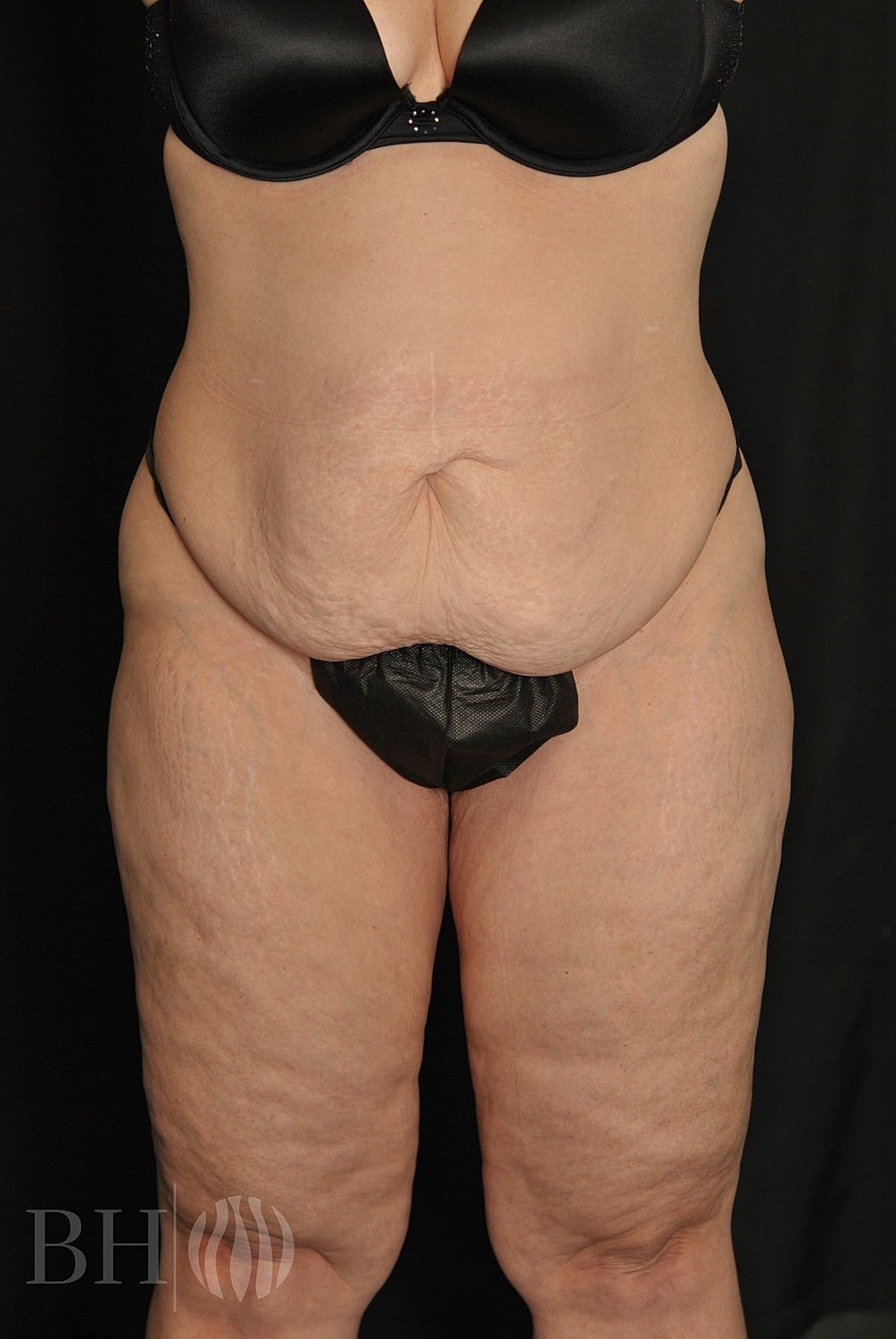 Tummy Tuck Before & After