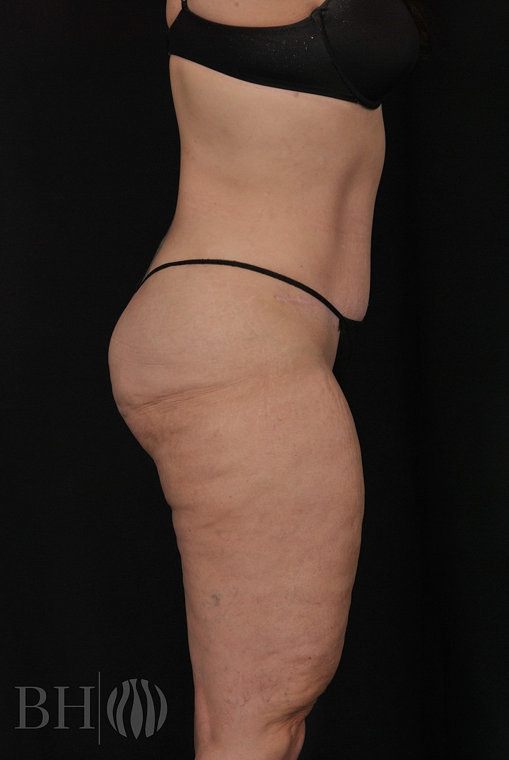 Tummy Tuck Before & After