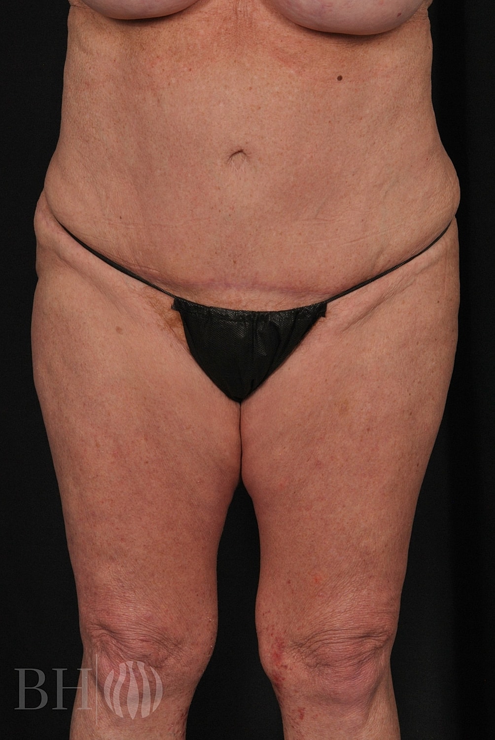 Tummy Tuck Before & After