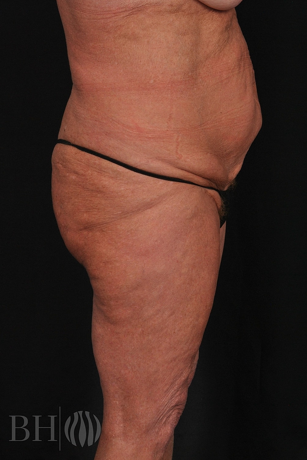 Tummy Tuck Before & After