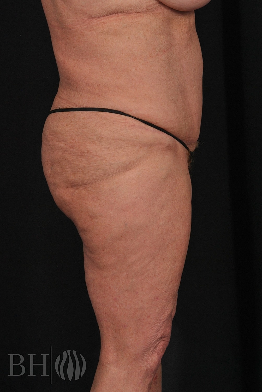 Tummy Tuck Before & After