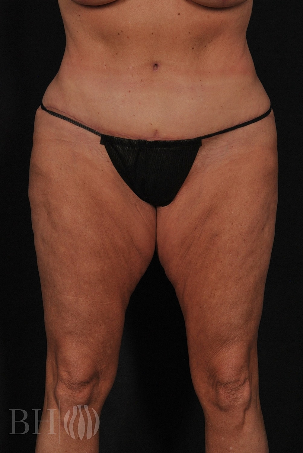 Tummy Tuck Before & After