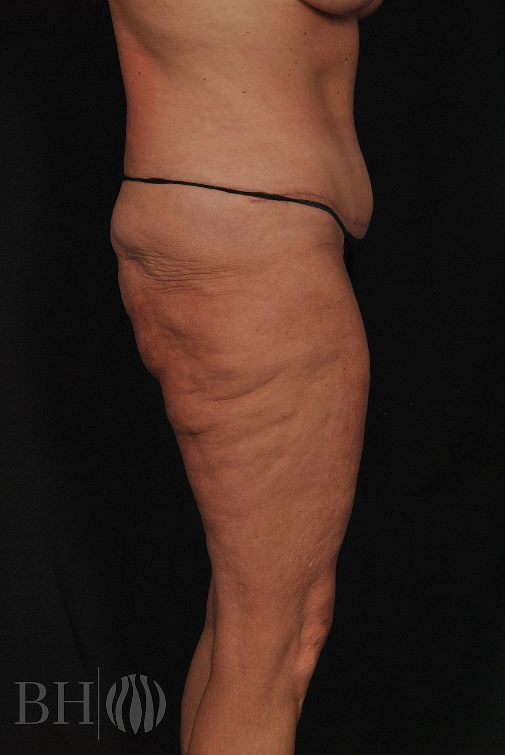 Tummy Tuck Before & After