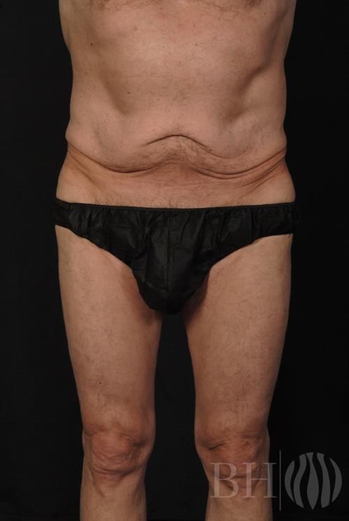 Tummy Tuck Before & After