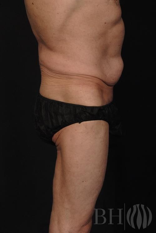 Tummy Tuck Before & After