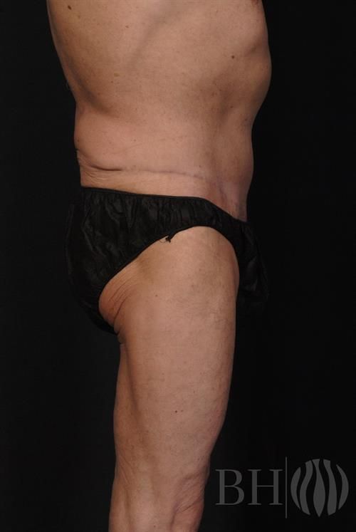 Tummy Tuck Before & After