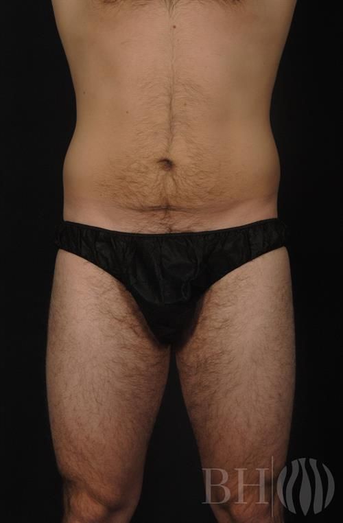 Tummy Tuck Before & After