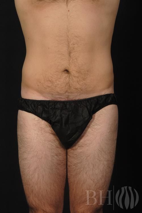 Tummy Tuck Before & After