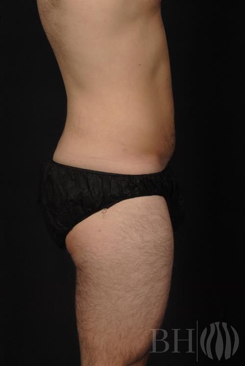 Tummy Tuck Before & After