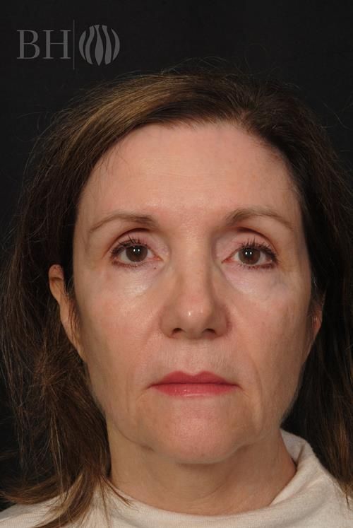 Facelift Before & After