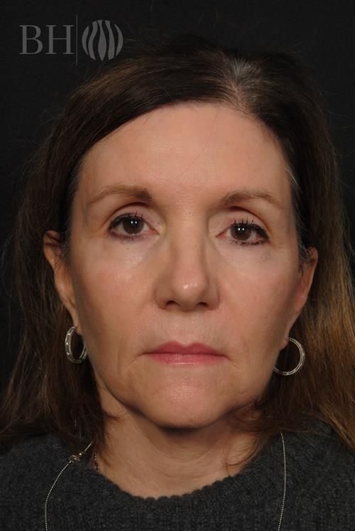 Facelift Before & After