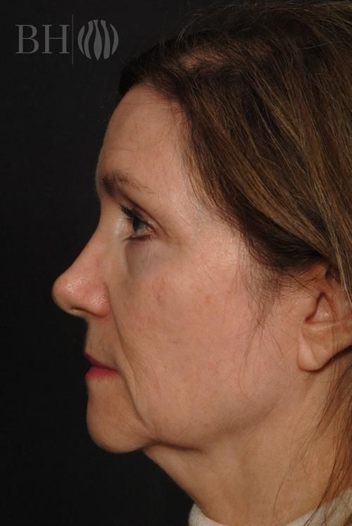 Facelift Before & After