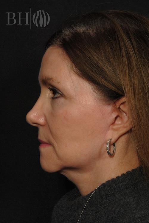 Facelift Before & After