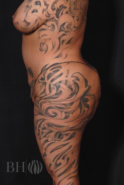 Liposuction Before & After