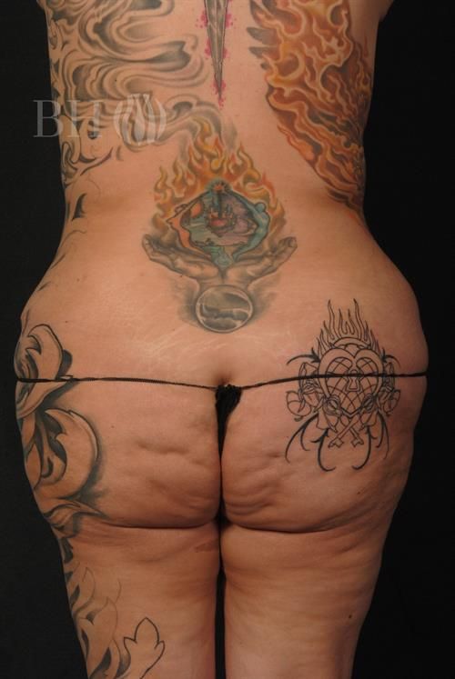 Liposuction Before & After