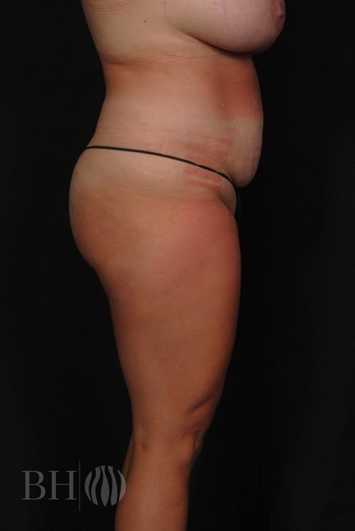 Liposuction Before & After