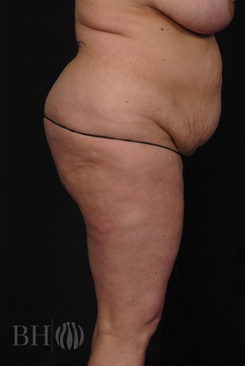 Liposuction Before & After