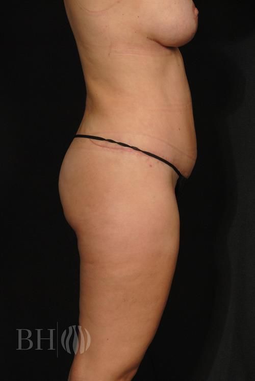Liposuction Before & After