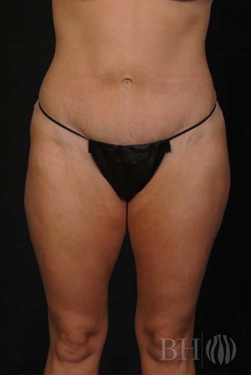 Liposuction Before & After