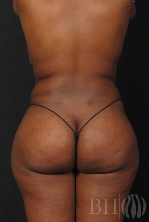 Liposuction Before & After