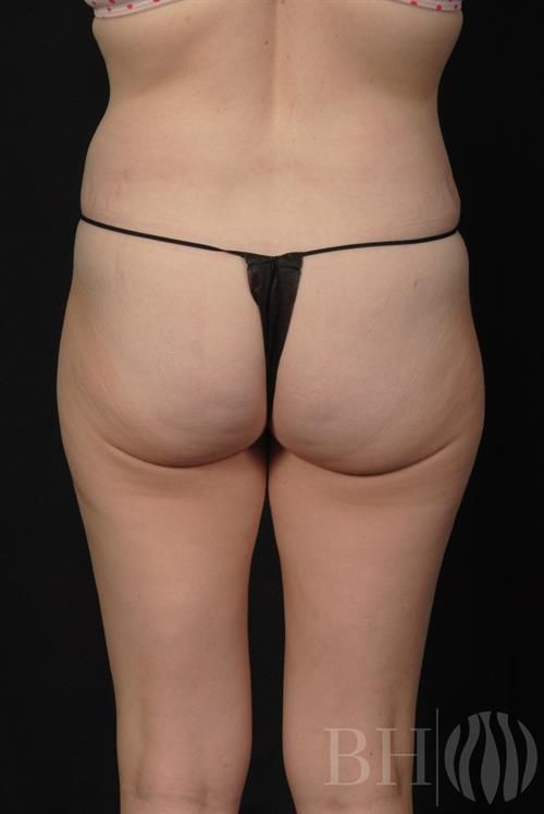 Liposuction Before & After