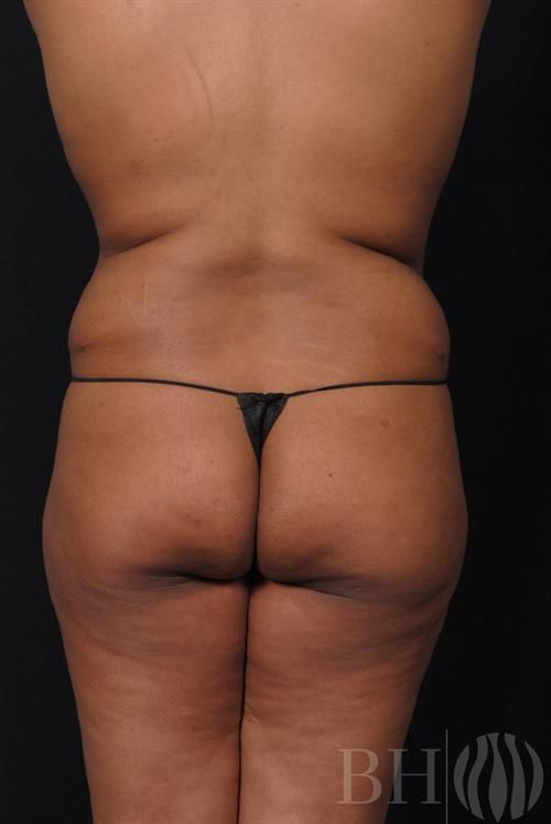 Liposuction Before & After
