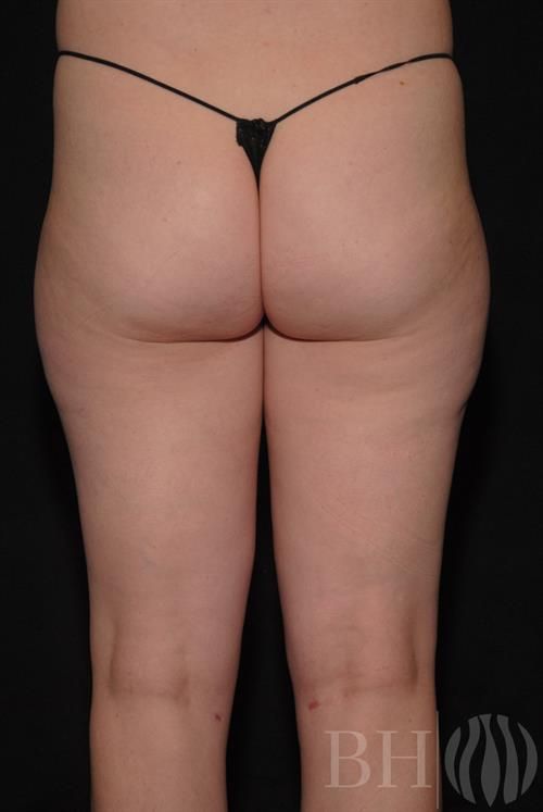 Liposuction Before & After