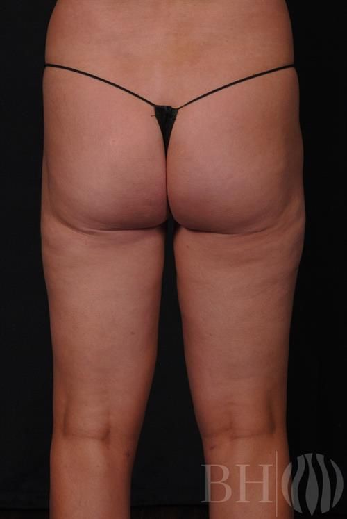 Liposuction Before & After