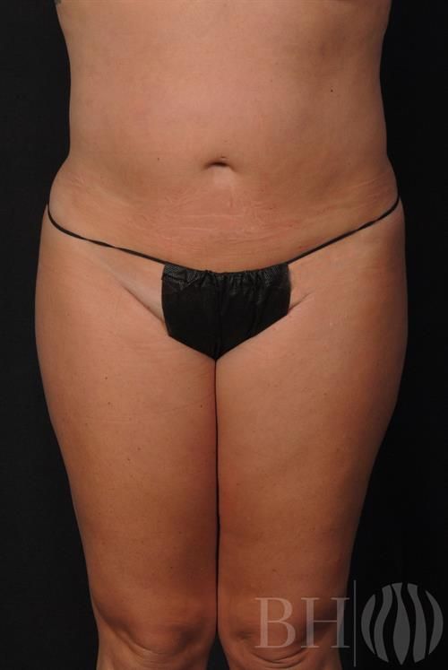 Liposuction Before & After
