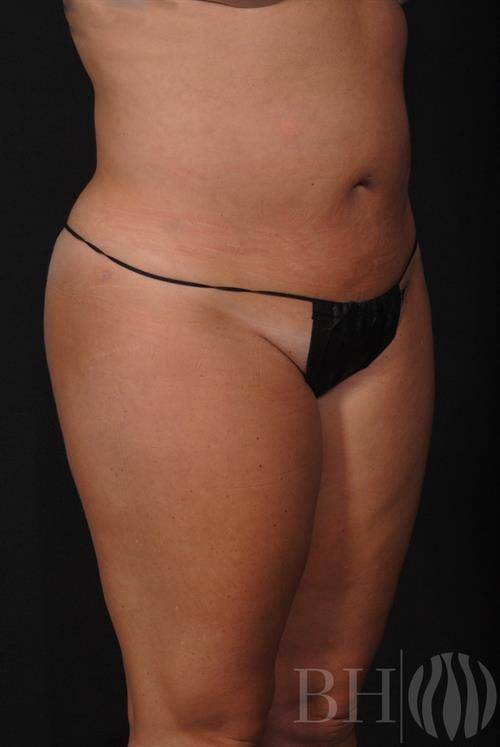 Liposuction Before & After