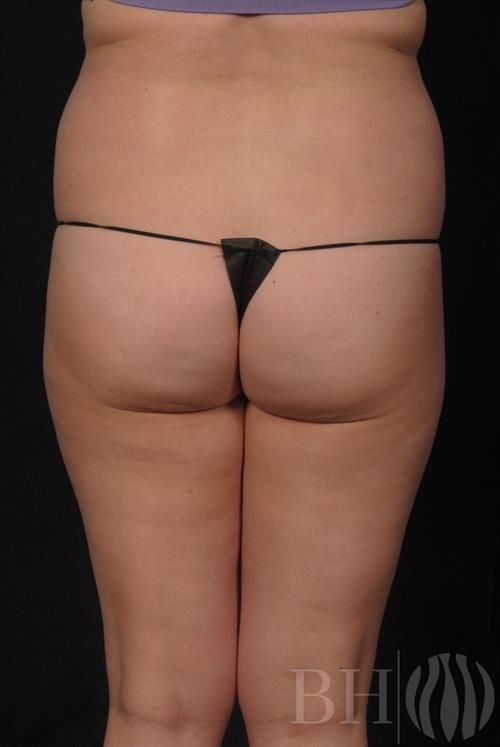 Liposuction Before & After