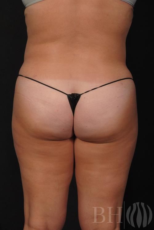 Liposuction Before & After