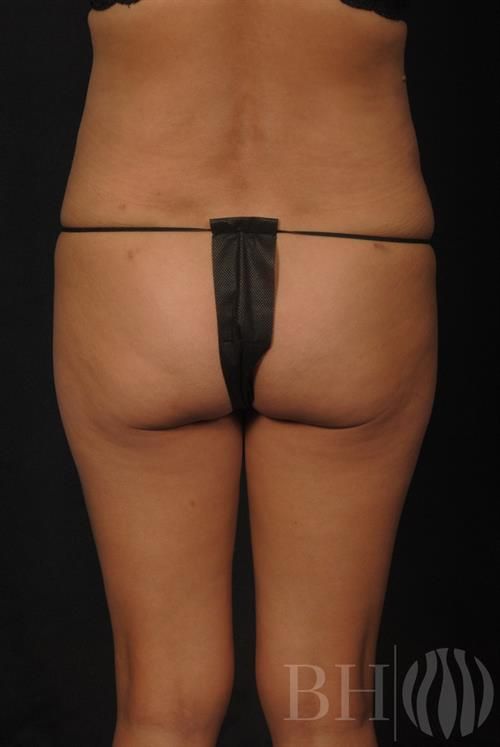 Liposuction Before & After