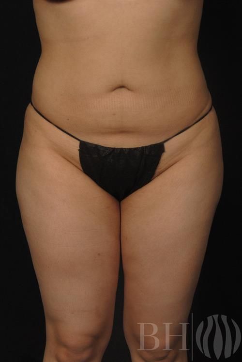 Liposuction Before & After