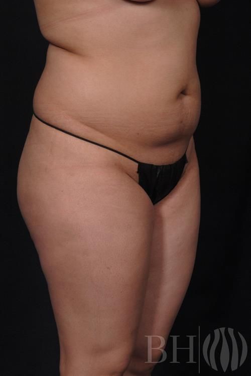 Liposuction Before & After