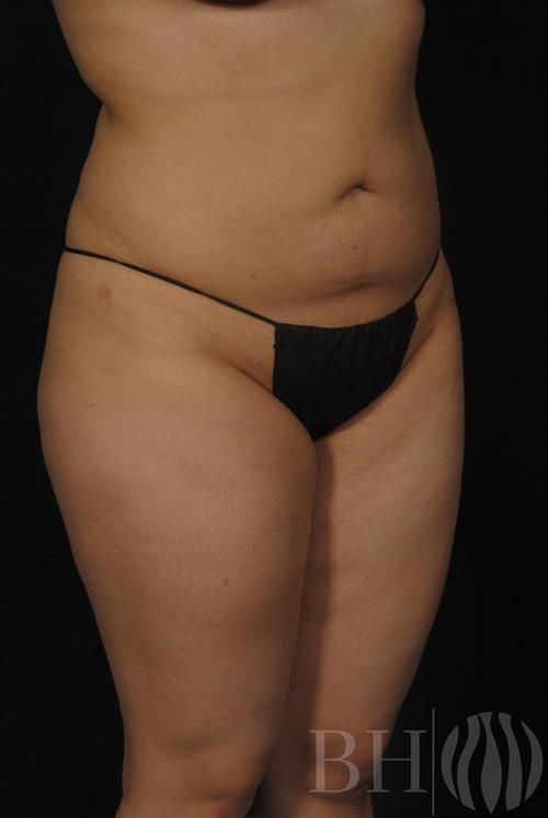 Liposuction Before & After