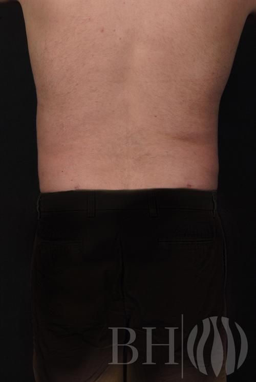 Liposuction Before & After