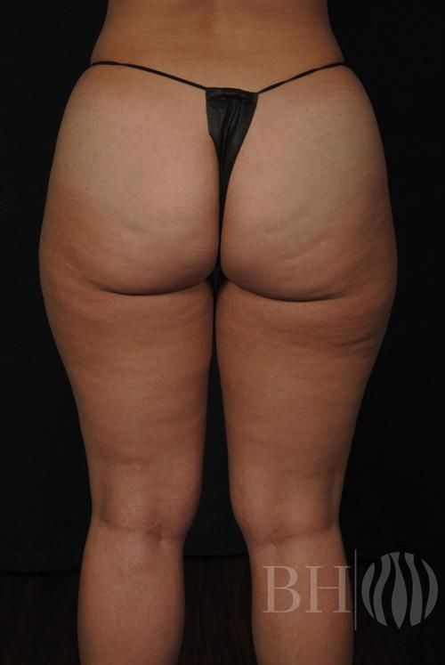 Liposuction Before & After