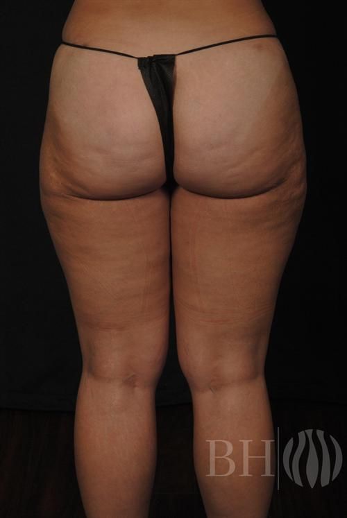 Liposuction Before & After