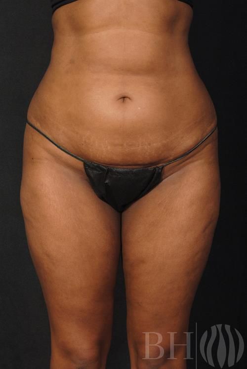 Liposuction Before & After